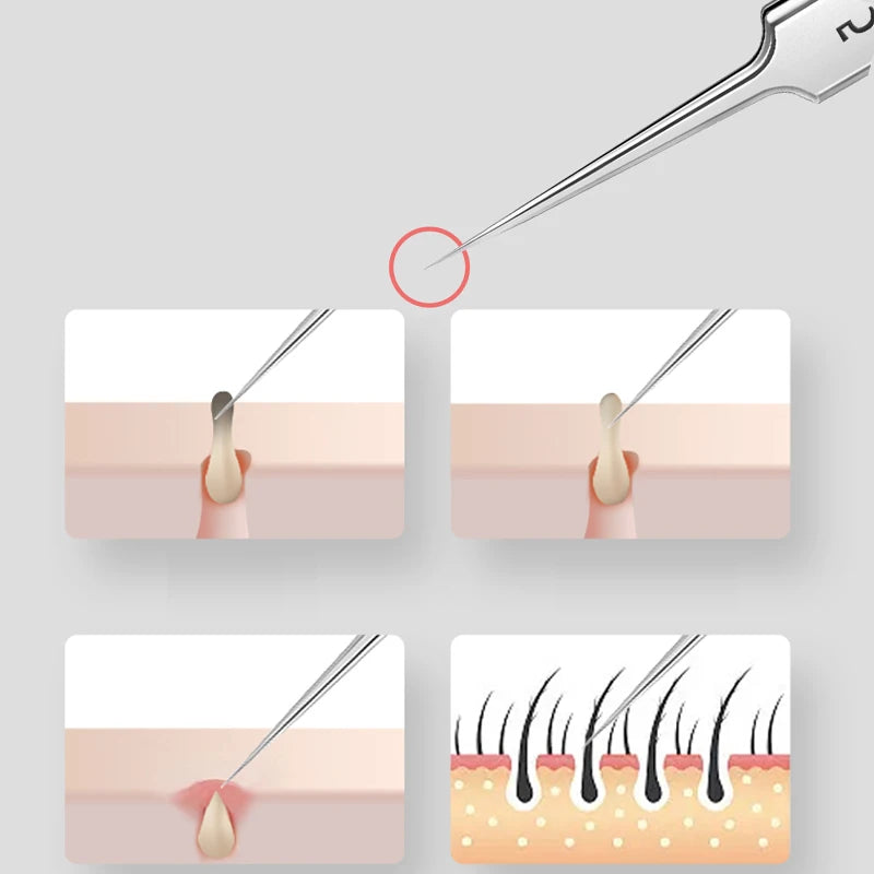 Deutsch Ultrafein Nr. 5-Zellen-Pickel-Pinzette mit Mitesser-Clip, Schönheitssalon, spezielles Kratz- und Schließartefakt, Akne-Nadelwerkzeug